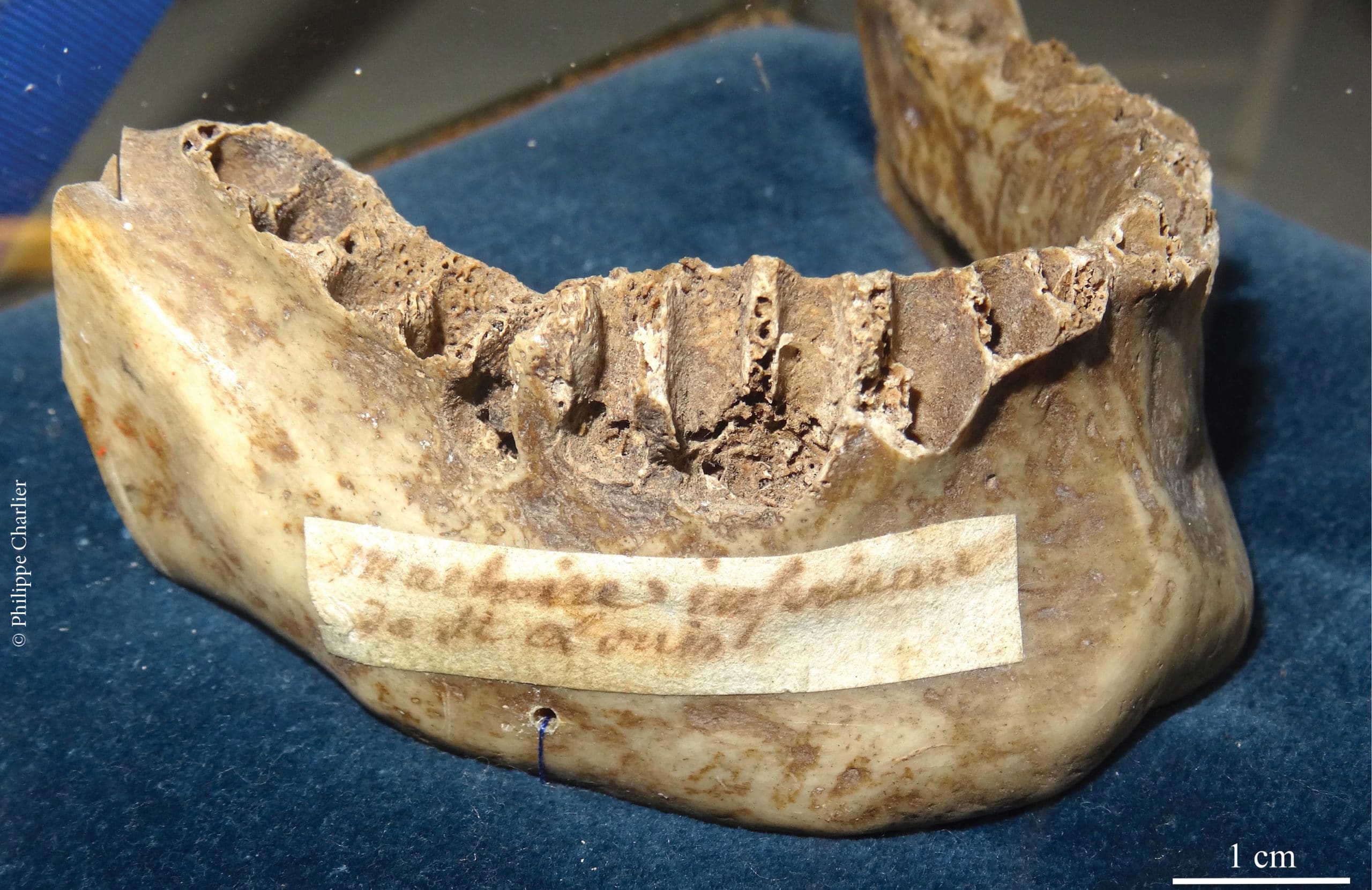 Saint-Louis n’est pas mort de la peste…mais du scorbut !